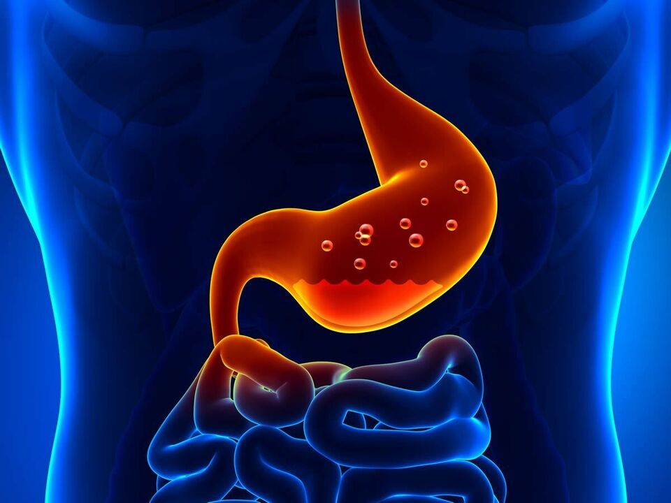 La gastritis es una enfermedad inflamatoria del estómago que requiere